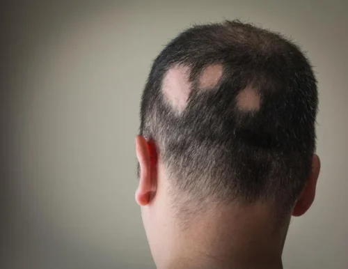 can alopecia areata be treated